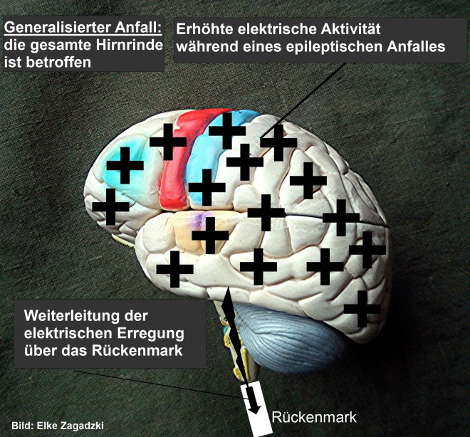 Generalisierter Anfall